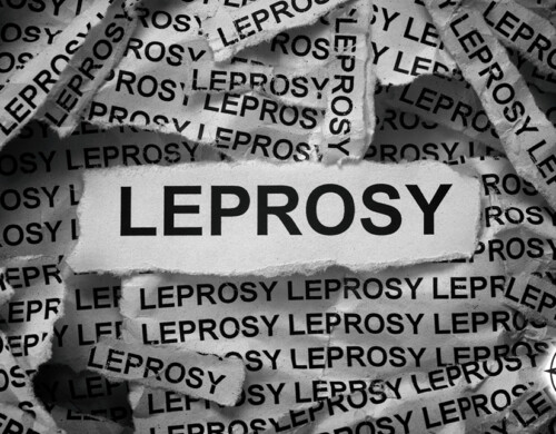 Leprosy on the Rise in Central Florida: A Historical and Modern Perspective