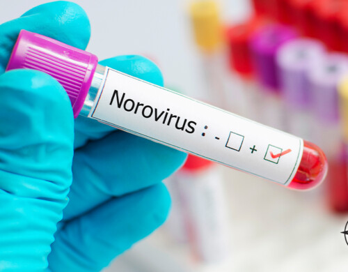 Norovirus – The Unwelcome Invader: Causes, Symptoms, and Treatment Options