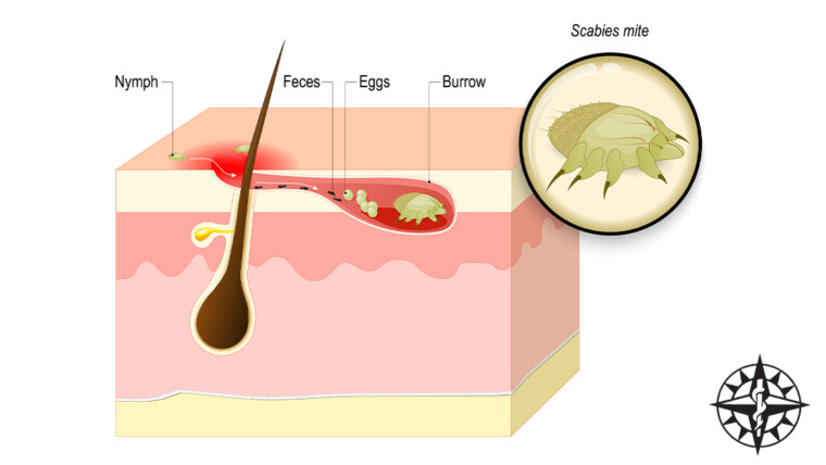 Human Scabies and Skin Mites